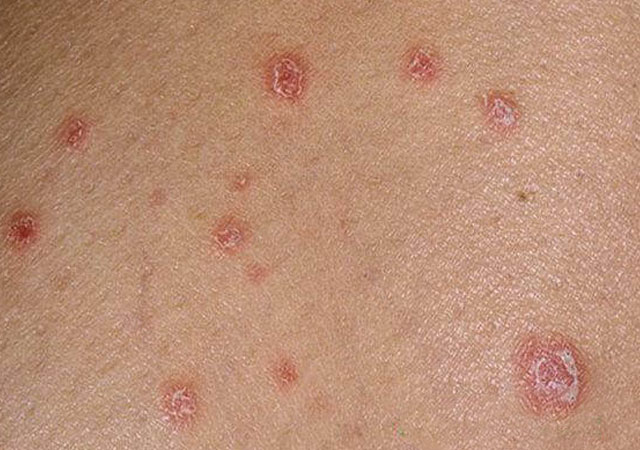 银屑病初期症状:明显的皮疹边界,存在剥离,在摩擦时增加.