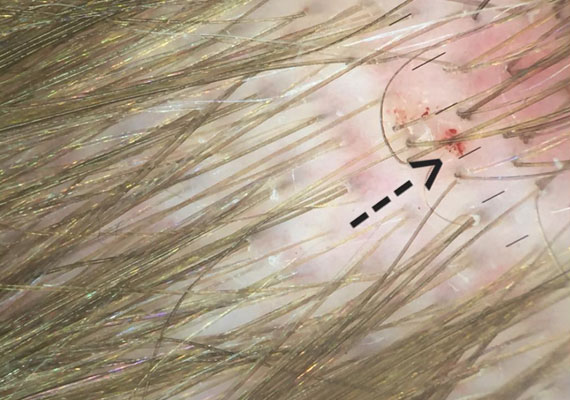 头皮发红发痒原因是银屑病还是脂溢性皮炎如何区分